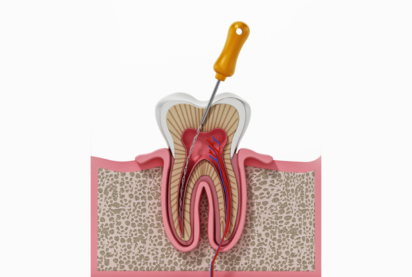 Root Canal Treatment