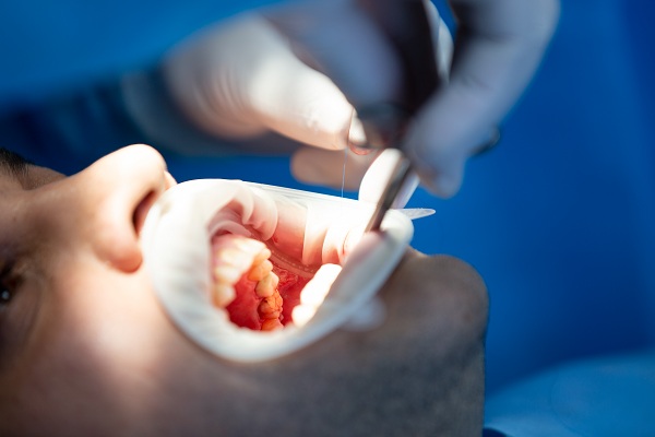 Gum Surgery