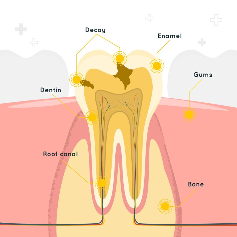 RCT Treatment