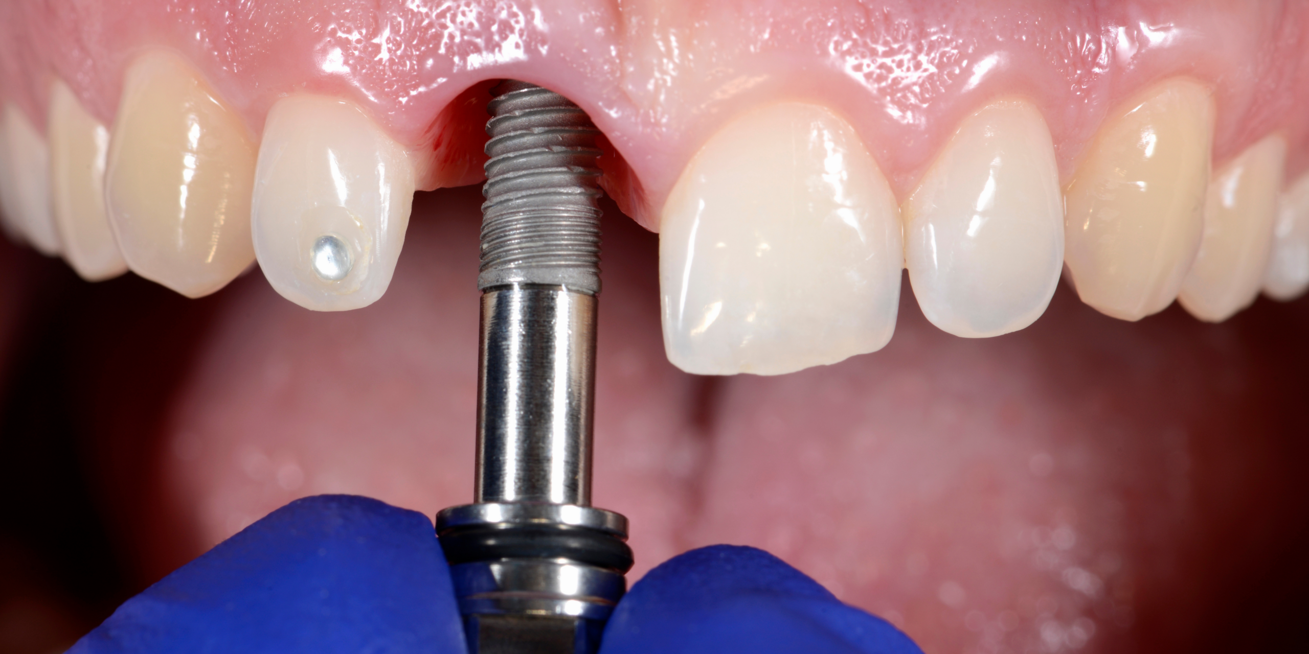 Dental Implants