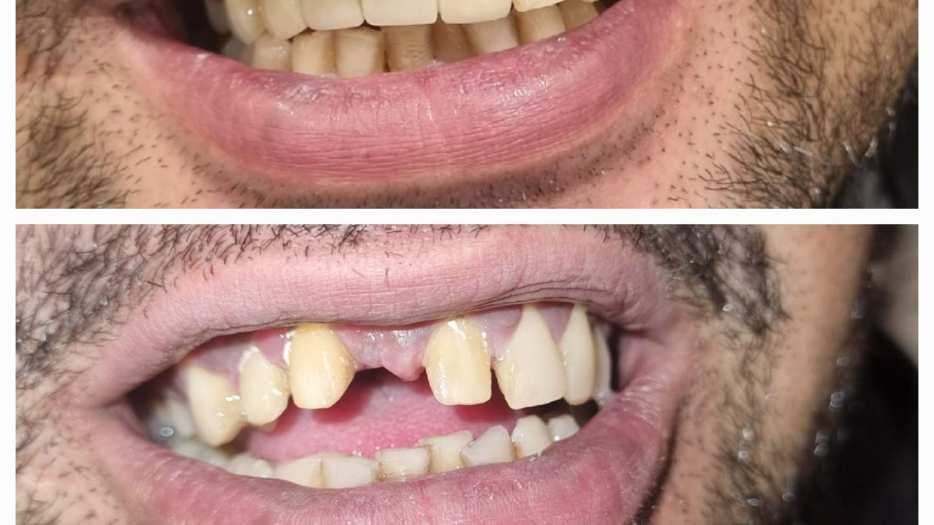 Dental Implants vs Bridges: Which Is Right for You?