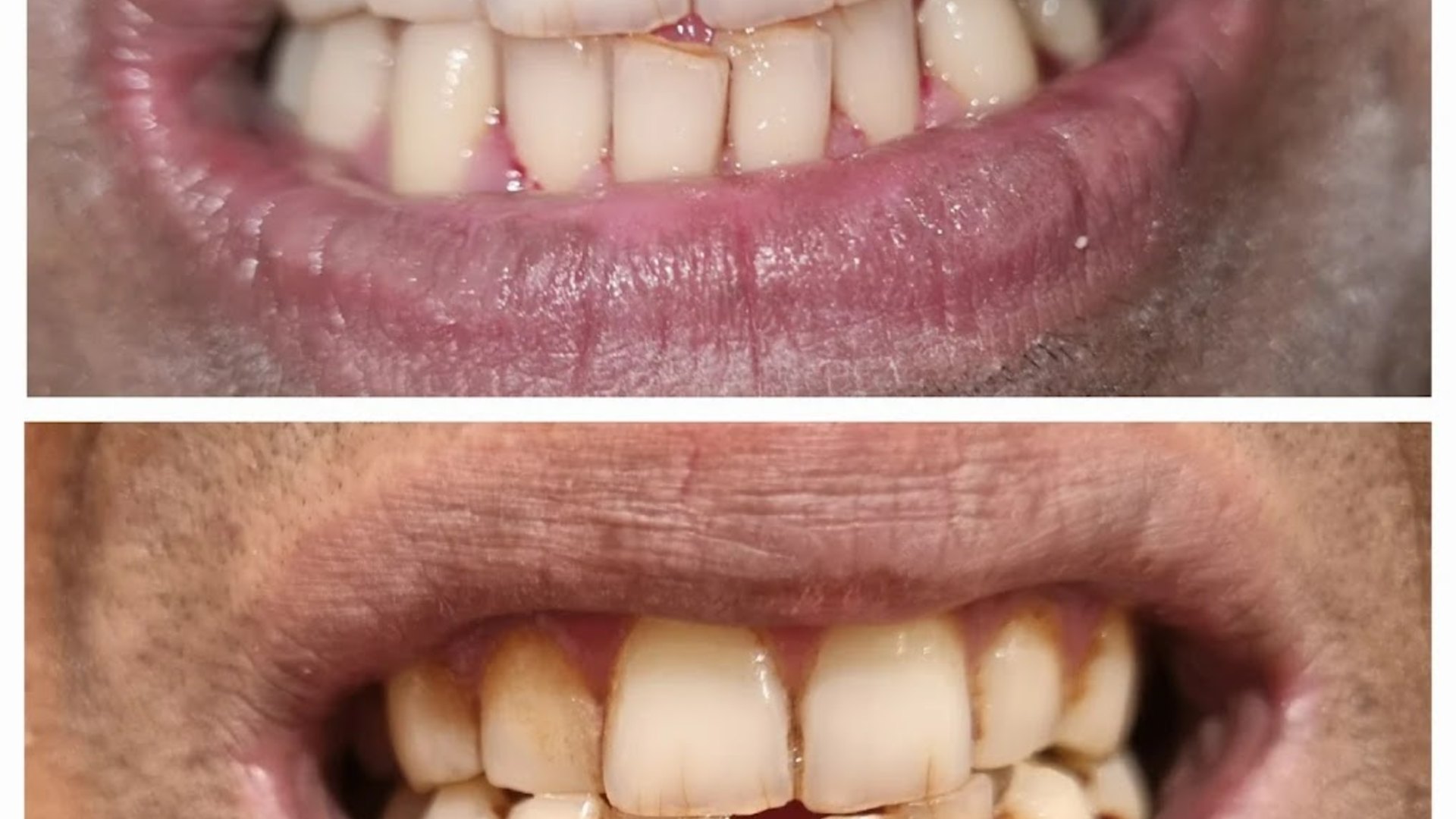 Beyond the Quick Fix: Why Comprehensive Smile Rehabilitation and Dental Implants Are Changing Modern Dentistry