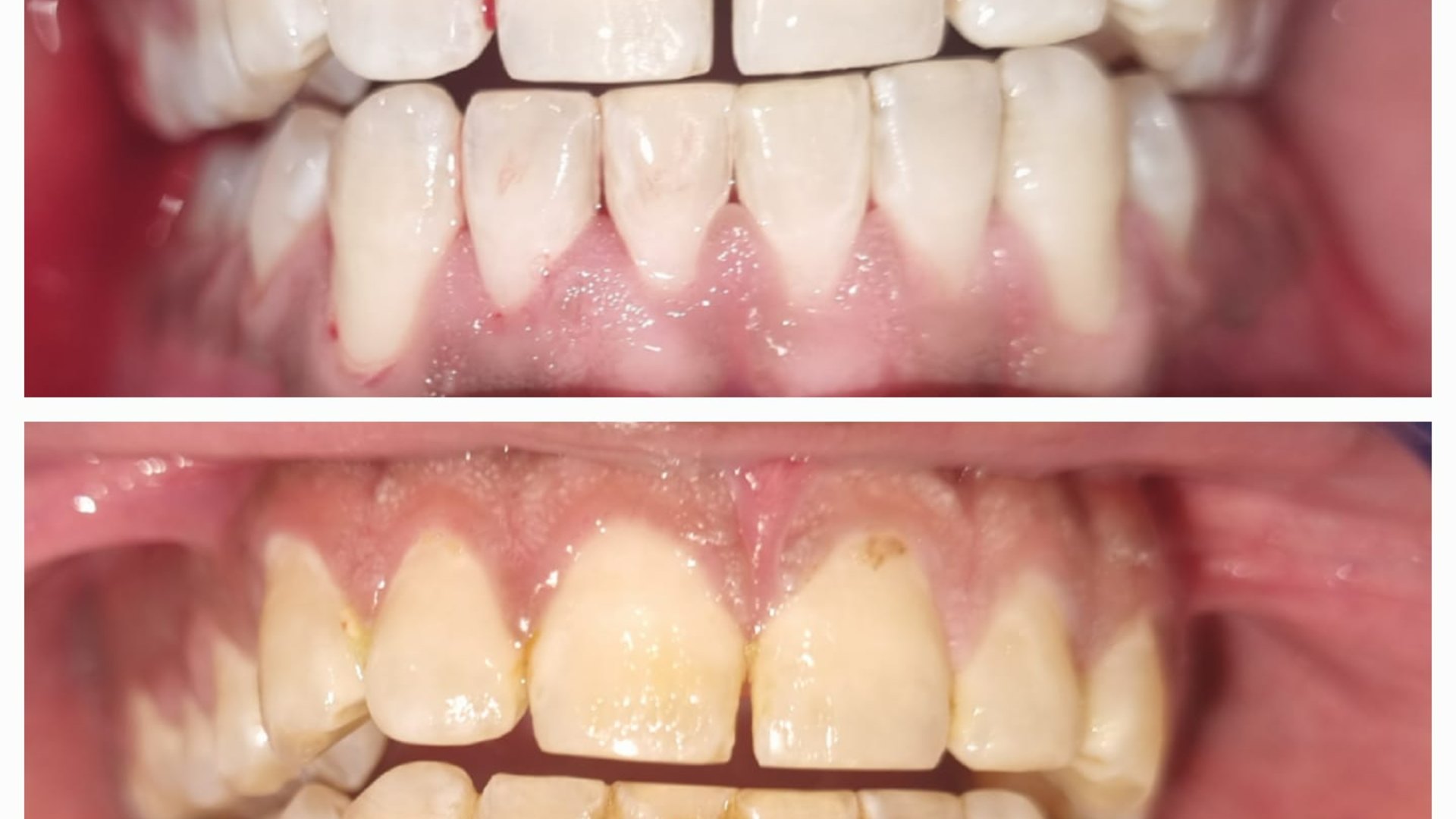 Veneers or Smile Makeover? How to Choose the Right Cosmetic Treatment