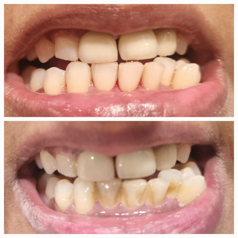 Clear Aligners & Braces