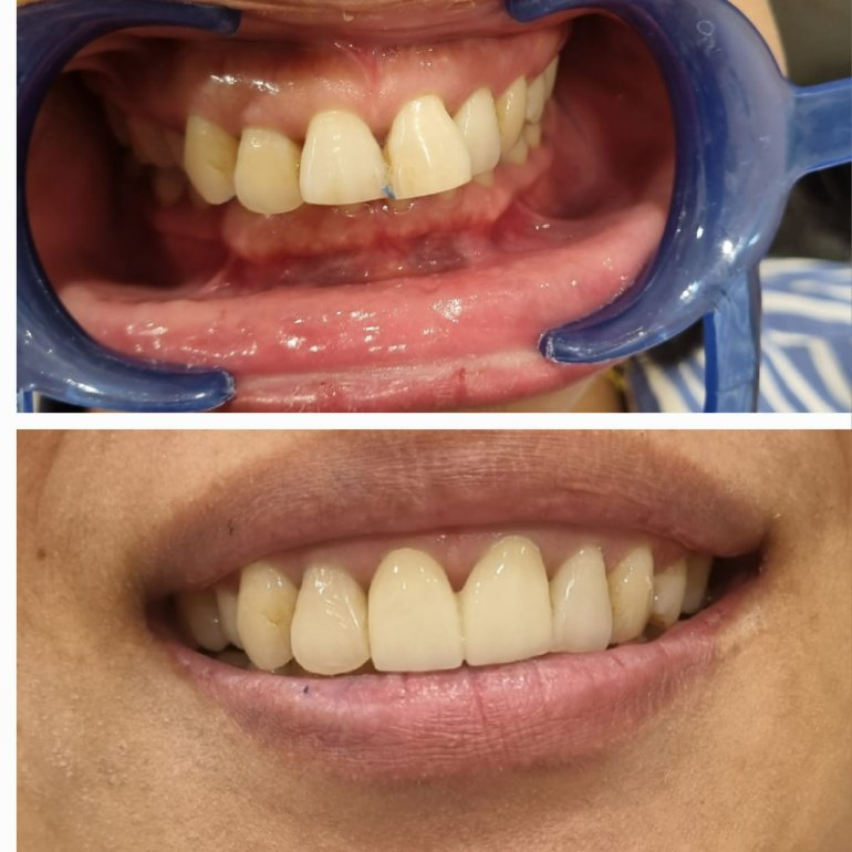 Dentures