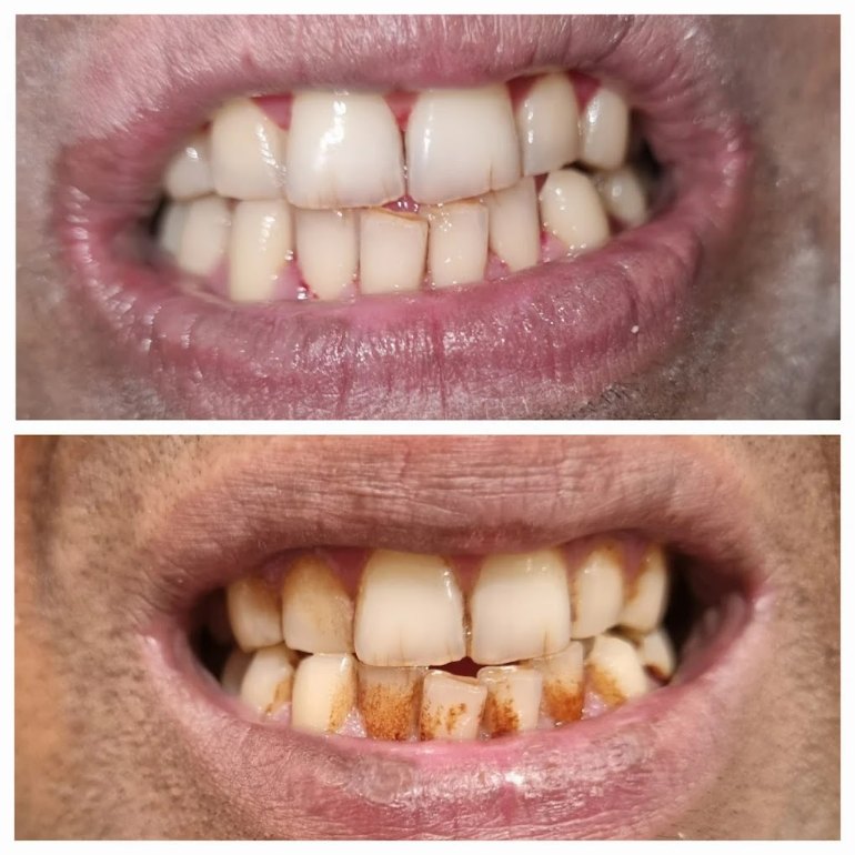 Full-Mouth Rehabilitation