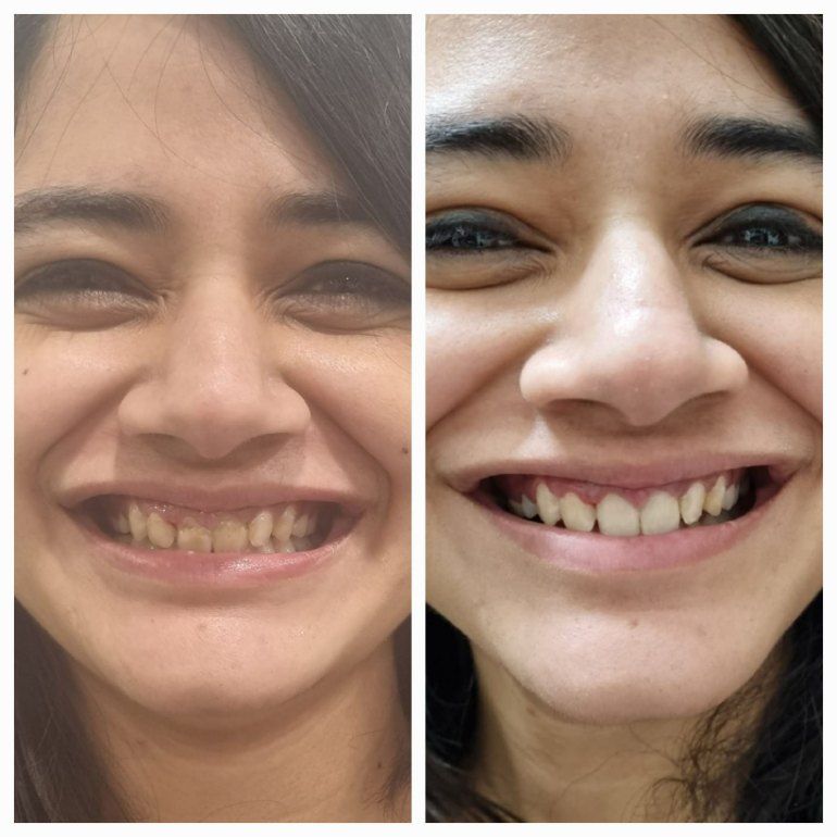 Smile Makeover