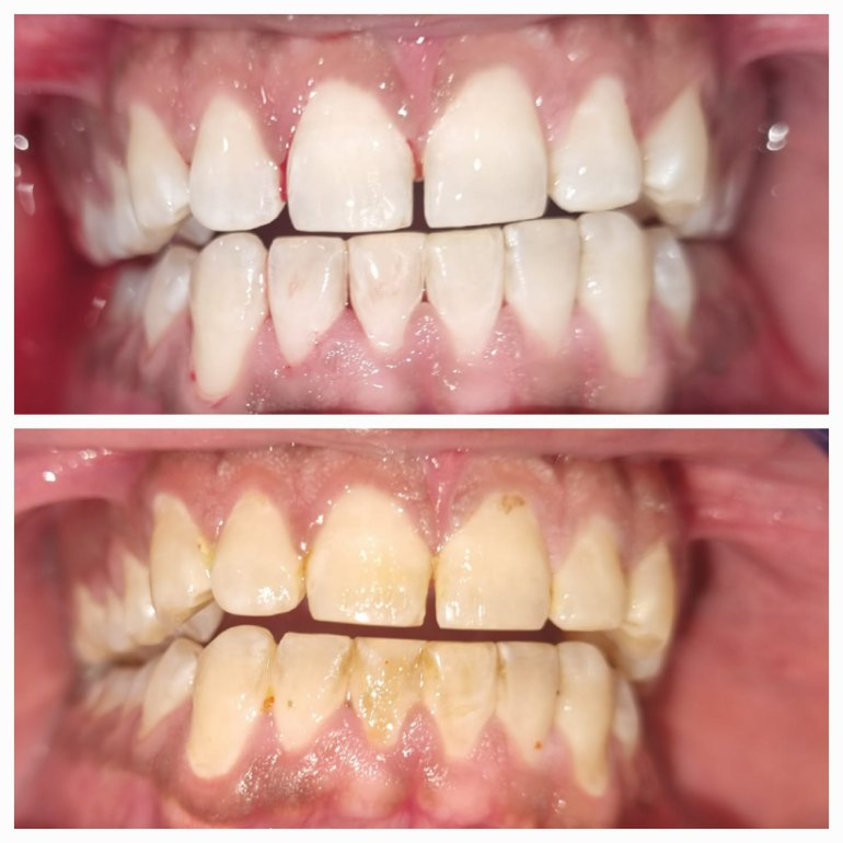 Dental Veneers