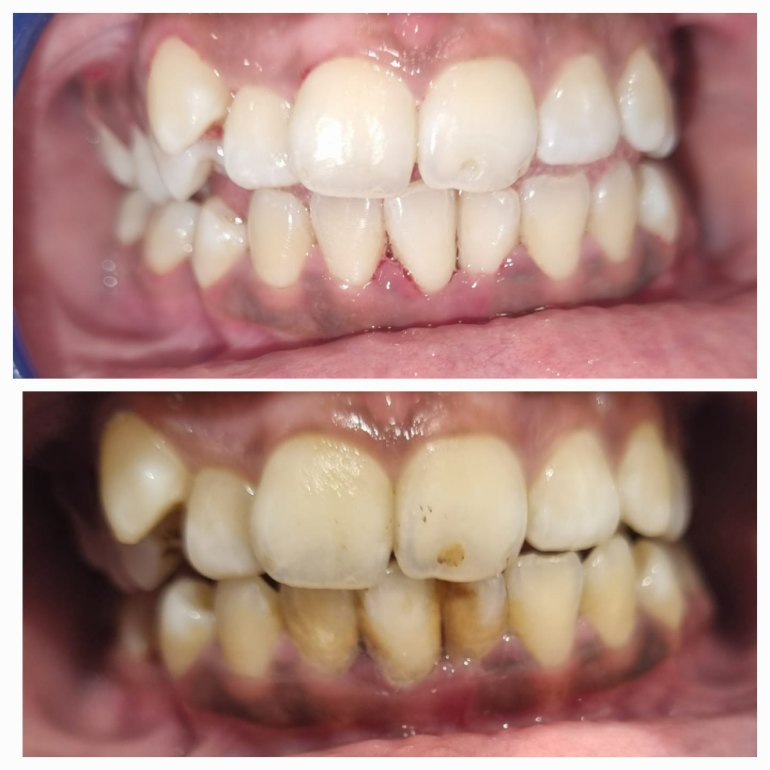 Teeth Whitening